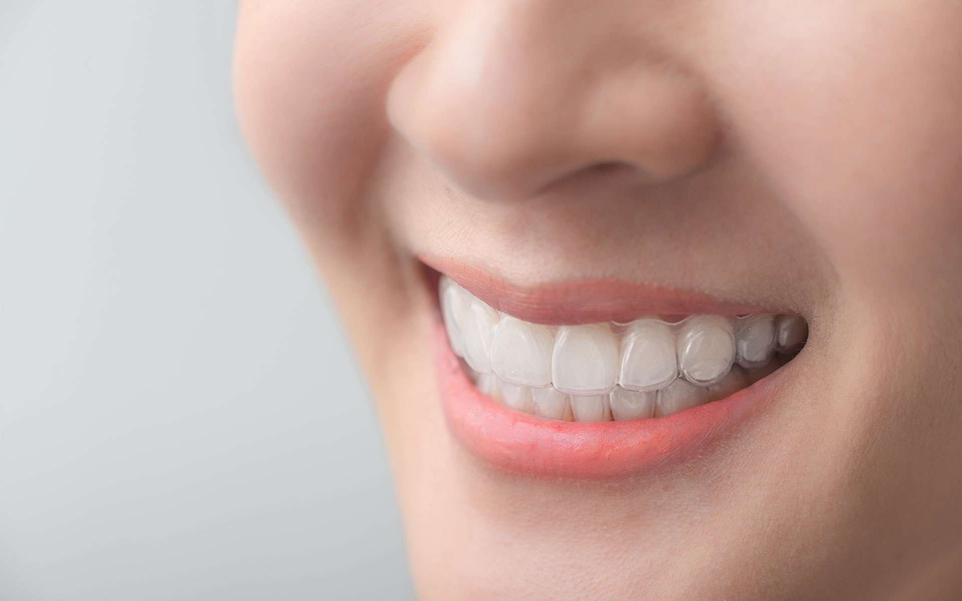 Close-up of a person smiling, showing their teeth fitted with clear orthodontic aligners. The lips are slightly parted and the background is plain and light-colored.