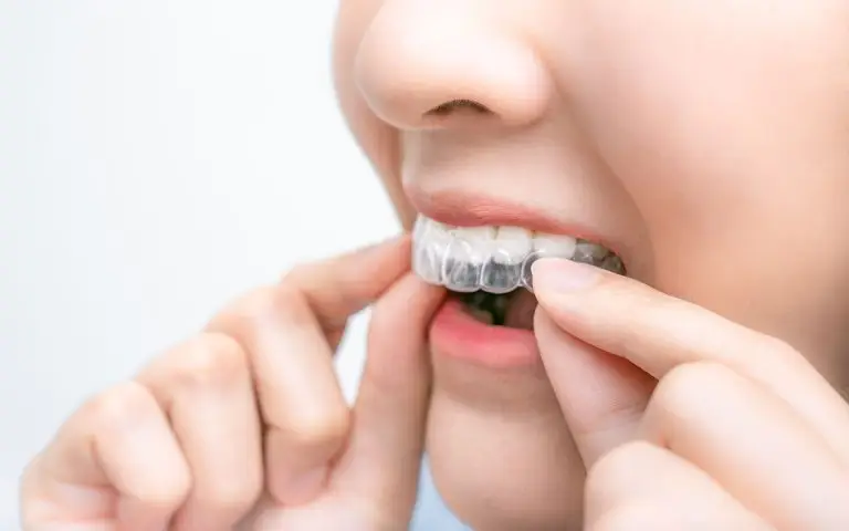 A person close-up placing a clear dental aligner over their upper teeth with their fingers, showing part of their nose and mouth—perfect for those considering a Take Home Whitening System to enhance their smile.
