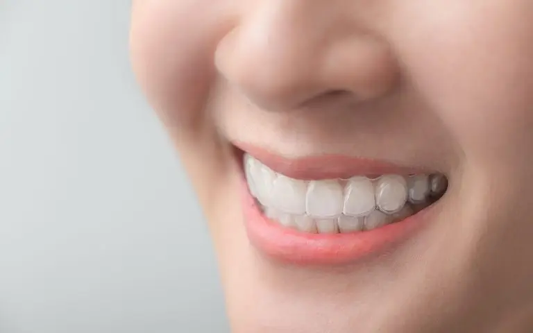 Close-up of a persons smile showing clear aligners fitted over their teeth for orthodontic treatment. The person’s lips are slightly parted, revealing the transparent aligners and results enhanced by a Take Home Whitening System.