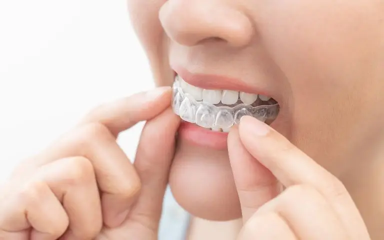 A person is inserting a clear dental aligner over their upper teeth, holding it with both hands. The image highlights their mouth and hands, similar to using a Take Home Whitening System for brighter teeth.