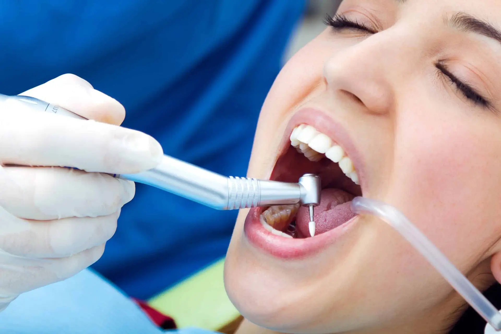 patient getting a composite-filling in mission viejo