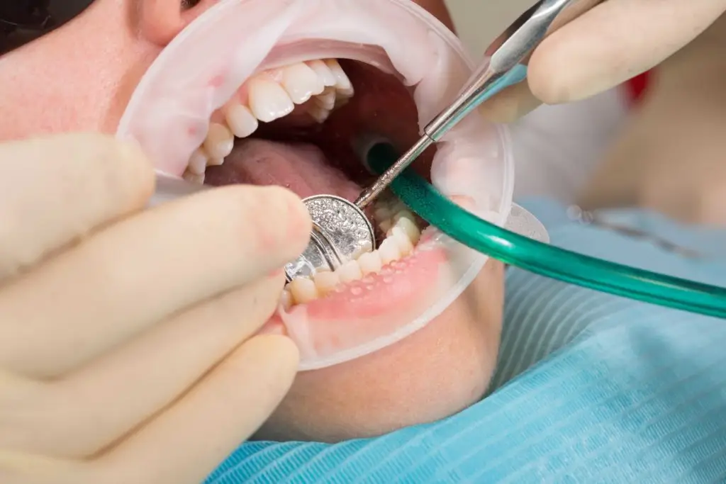 patient getting a dental crown in Mission Viejo at saddleback dental associates