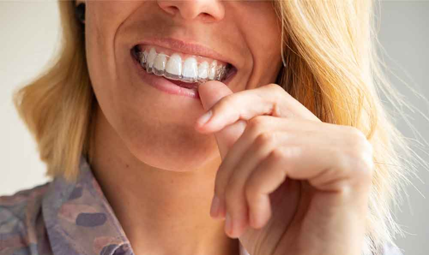 invisalign mission viejo