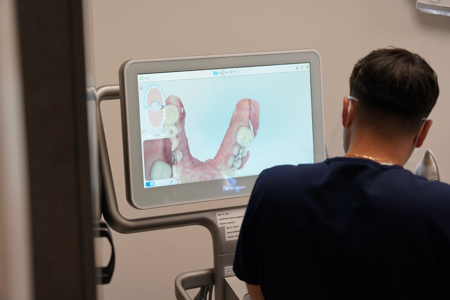 itero dental 3d scanner